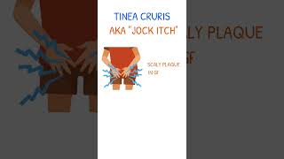 TINEA CRURIS