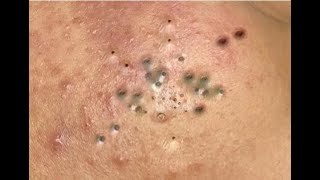 Shocking Cystic Blackheads \u0026 Whiteheads Extraction Revealed / new blackheads this week 12-319