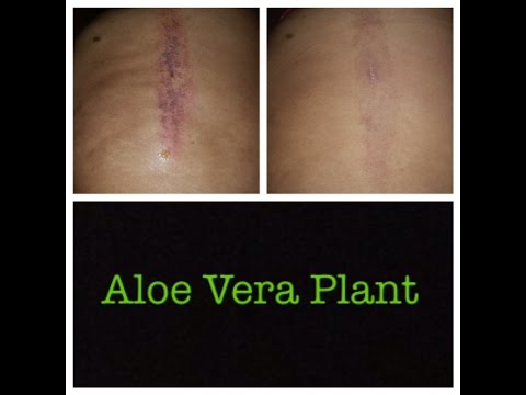 Aloe Vera gel for burns and scars Aloe Vera gel for burns and scars
