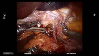 Concomitant Biliopancreatic Diversion w/ Duodenal Switch \u0026 Hiatal Hernia Repair