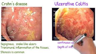 Crohn's disease vs Ulcerative Colitis made simply