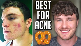 Three Best & Worst Foods For Acne Pt. 2 (FROM EXPERIENCE!)