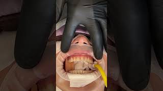 Porcelain Veneer Delivery from Start to Finish - Inside the Process