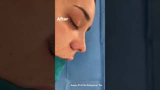 Closed Rhinoplasty Before and After