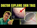 Doctor explains SKIN TAGS - including CLINICAL PHOTOS, CAUSES & TREATMENT