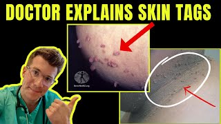 Doctor explains SKIN TAGS - including CLINICAL PHOTOS, CAUSES & TREATMENT