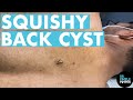 Dr Pimple Popper Removes Back Cyst Clean! No Blood!