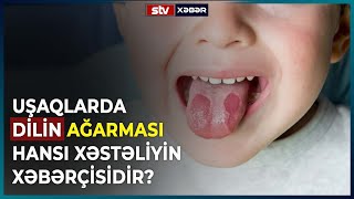 UŞAQLARDA DİLİN AĞARMASI HANSI XƏSTƏLİYİN XƏBƏRÇİSİDİR? - STV XƏBƏR