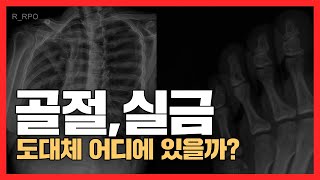 골절,실금 x-ray에서 어떻게 보일까요?