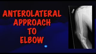 Anterolateral Approach to Elbow: Humerus Plating Techniques | Surgical Approaches by Dr. Deepak Garg