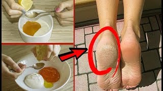 ஒரே இரவில் இப்படி மாற ஆசையா?| Home Remedy for Cracked Heels Tamil  | Tamil Beauty Tips