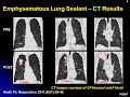 controversies in bronchoscopy aspirin clopidogrel pregnancy fluoroscopy elevated icp