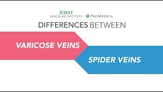 Differences between Spider Veins vs. Varicose Veins