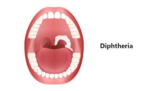 Pathophysiology of Diphtheria by Jyothisrii