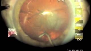 Hydrodissection and Nucleus Rotation