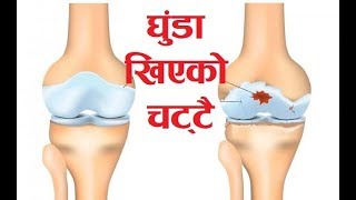 घुडा खिइएको चट्टै; Dr.  Sunil Paudel, Short \u0026 Bitter, Episode 2, Osteoarthritis of Knee, Knee Pain