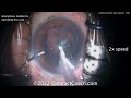 cataractcoach 1598 resident posterior polar cataract