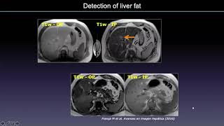 Webinar 20  'MR quantification of hepatic fat and iron how does it works in practice'M. França