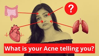 Pimple kaise hote hai | What is your acne telling you? : Face mapping| They Reveal About Your Health