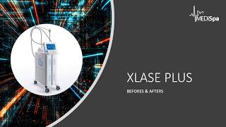 XLASE PLUS - BEFORES \u0026 AFTERS