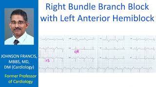 Right bundle branch block with left anterior hemiblock