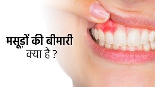 मसूड़ों की बीमारी क्या है | क्रोनिक इन्फेक्शन | मसूड़ों के बीमारी के लक्षण और मसूड़े की बीमारी