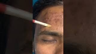 Benefits Of Double Peel treatment For Men | Viral #shorts