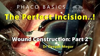 Phaco Basics-The Perfect Incision -Wound Construction(Part 2)-Incision Configuration.Dr Deepak Megur