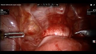 Robotic Isthmocele repair surgery