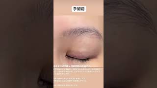 逆さまつげ手術+目頭切開　1週間後。trichiasis surgery+medial epicanthoplasty. 1week after surgery. Shinya Ogishima.