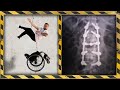 How Richard Corbett became Paralyzed (Spinal Cord Injury Story)