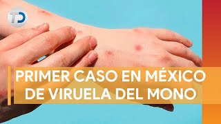 Confirman primer caso de viruela del mono en México