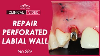 Upper Anterior Immediate Implant Placement with Immediate Restoration [Dr. Kim Jaeyoon]