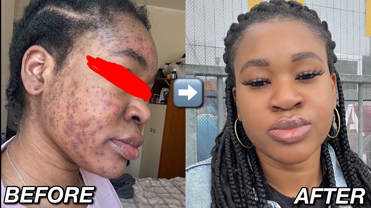 How I Cleared My Acne And Blackspots | HOW I CLEARED MY ...