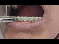 how i remove braces ብሬስ ስፈታ ተመልከቱ