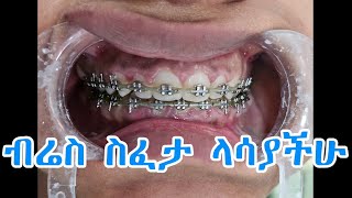 how I  remove braces/ብሬስ ስፈታ ተመልከቱ