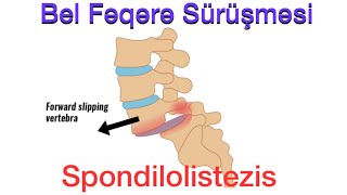 Dar kanal (stenoz) və fəqərə sürüşməsi (spondilolisteziz) implant əməliyyatı