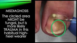 Video - septic toe nail treated by trephining