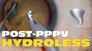 Phaco Clip #212 - Post PPPV Hydroless Approach