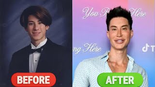 CELEBRITY BEFORE AND AFTER PLASTIC SUERGERY | JUSTIN JEDLICA