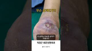 무슨 상처 인가?! (발뒤꿈치 욕창 소독 치료 병원 성형외과 bedsore pressure sore dressing seoul korea)[아문TV]