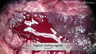 Ensure hemostasis by the use of topical clotting agents