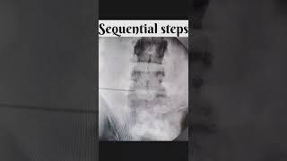 Transforaminal Endoscopic discectomy #spine #back #backpain #spinesurgeon #endoscopicspinesurgery