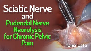 Sciatic Nerve and Pudendal Nerve Neurolysis for Chronic Pelvic Pain