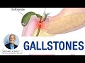 Gallstones - How they can form even on a vegan diet