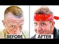 $3,000 Thai Hair Transplant Mistake? Surgeon Reacts