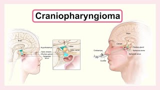 craniopharyngioma