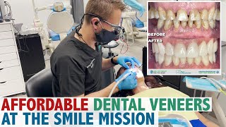 Affordable Dental Veneers At The Smile Mission