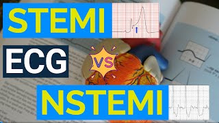 Decoding ECG Changes: STEMI vs NSTEMI - A Comprehensive Guide to Heart Attack Diagnosis.