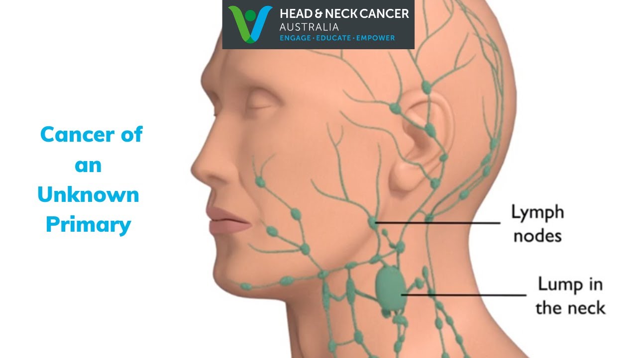 How Big Are Cancerous Lymph Nodes In Neck Infoupdate Org